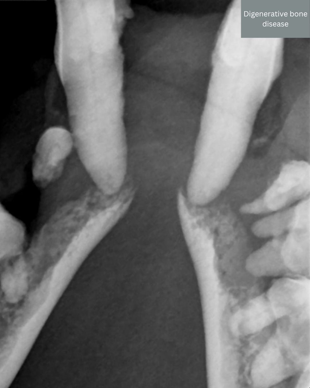 Bone Disease Periodontal Disease